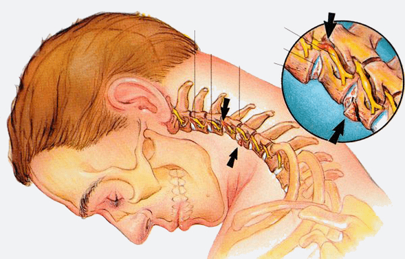 Stadiums of osteochondosis of the cervical column